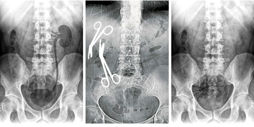 Reprezentare grafică a Primele trei cazuri prezentate de Libertatea: pacient cu rinichi pierdut (1), pacient în care a uitat două foarfeci (2), pacient în care a uitat un ghem de ațe (3) // Cele trei imagini reprezintă un fotomontaj și nu radiografiile pacienților