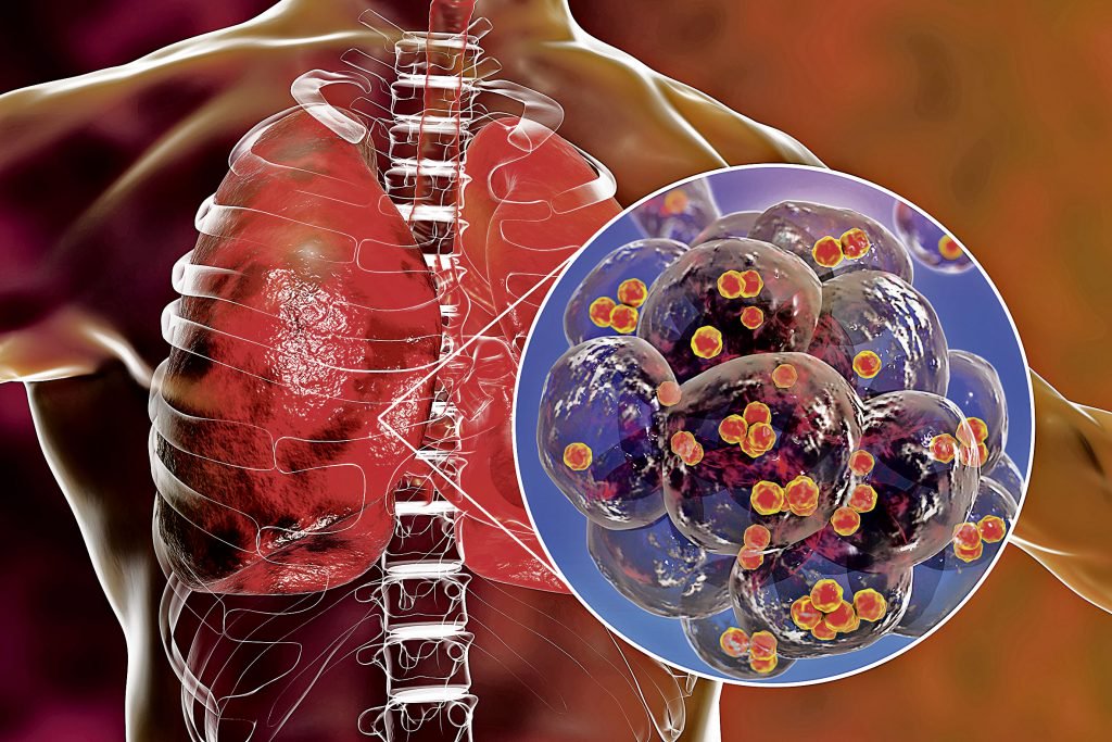 Stafilococul auriu e rezistent la tratament antibiotic. În infografie, bacteria, în interiorul alveolelor pulmonare